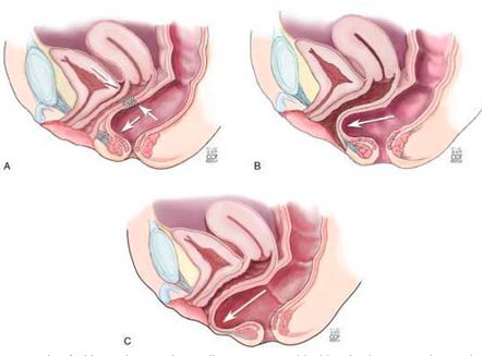 Rectocele / Enterocele